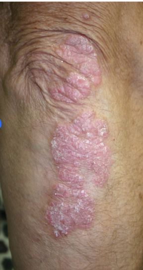 <p>It contributes to redness, swelling, pain, and plaque formation.</p>