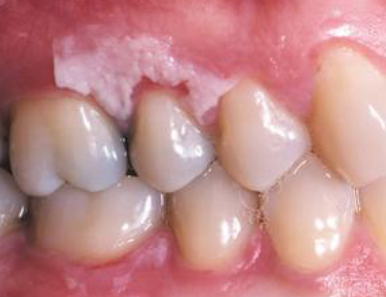<p>placing aspirin tablet or powder next to toothache </p>