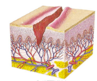 <p>linear breaks in the skin that goes from epidermis to dermis</p><p></p>