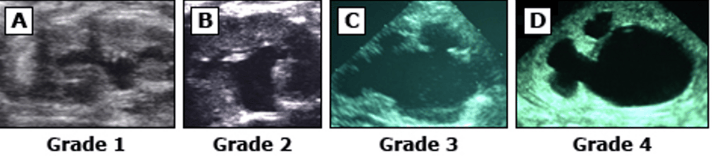 <p>0: No dilation</p><p>1: renal pelvis only visualized</p><p>2: renal pelvis and few calyces</p><p>3: all calyces are visualized</p><p>4: parenchymal thinning</p>