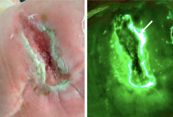 <ul><li><p>Organism: Psuedomonas aeruginosa</p></li><li><p><u>Gram-negative rod</u></p></li></ul><p></p>