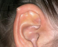 <p>possible normal variant</p>
