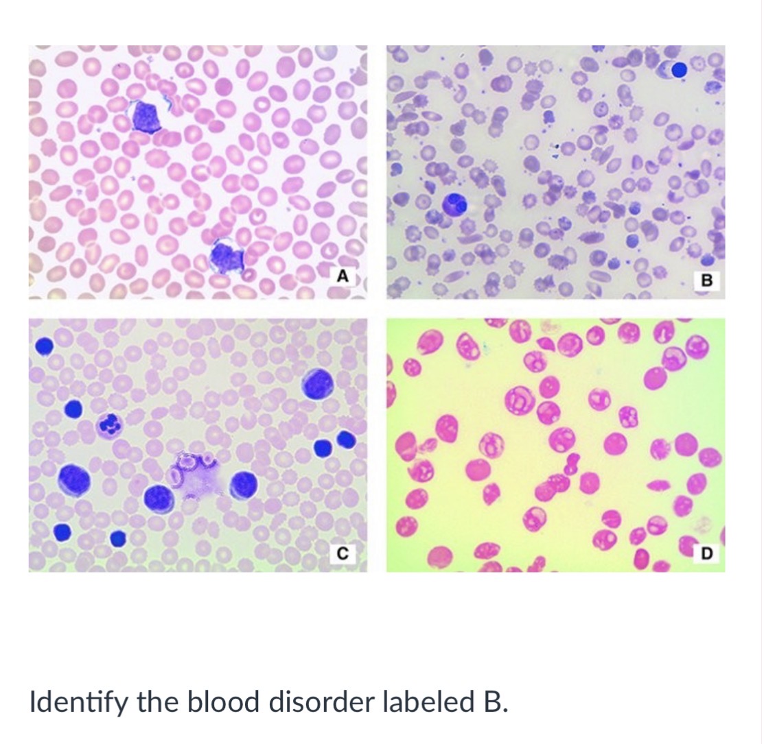 <p>Acute lymphoblastic leukemia</p><p></p><p>&nbsp;Mononucleosis</p><p>&nbsp;</p><p>Iron-deficiency anemia</p><p>&nbsp;</p><p>Sickle-cell anemia</p>