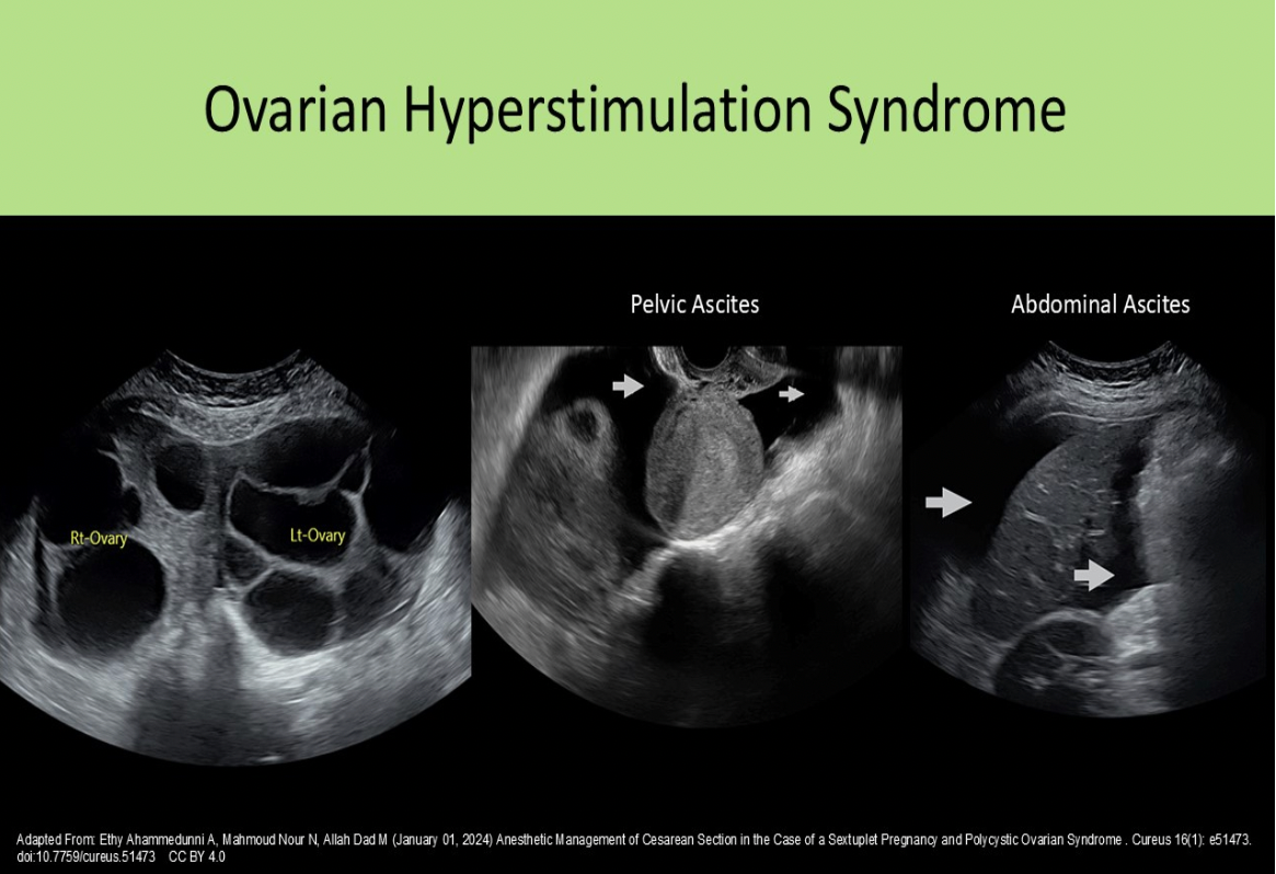 <p>D. increased echogenicity of the ovaries</p><p>Ascites and pleural effusion can be associated with ovarian hyperstimulation due to changes in blood characteristics and reduced renal filtration function. The ovaries are enlarged bilaterally (>5cm) with the formation of numerous cysts over 2cm.</p>