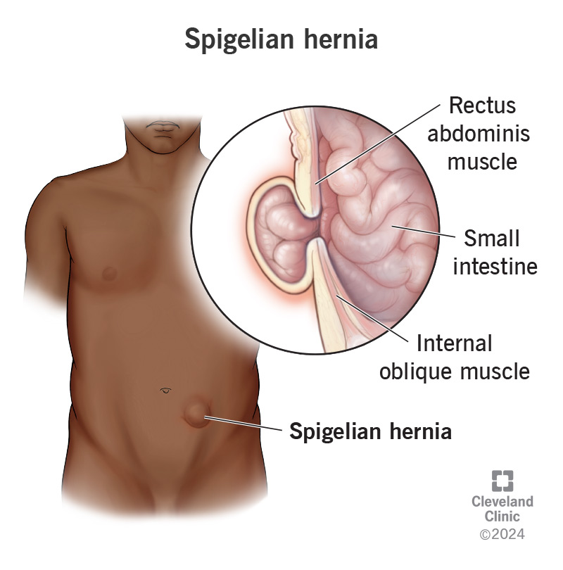 <ul><li><p>hernial sac composed of <strong>peritoneum</strong></p><ul><li><p>often covered by only <strong>skin + subcut. fat </strong>along semilunar lines (lat. to <strong>rectus sheath</strong>)</p></li></ul></li><li><p>common in <strong>40+, obese</strong></p></li></ul><p></p>