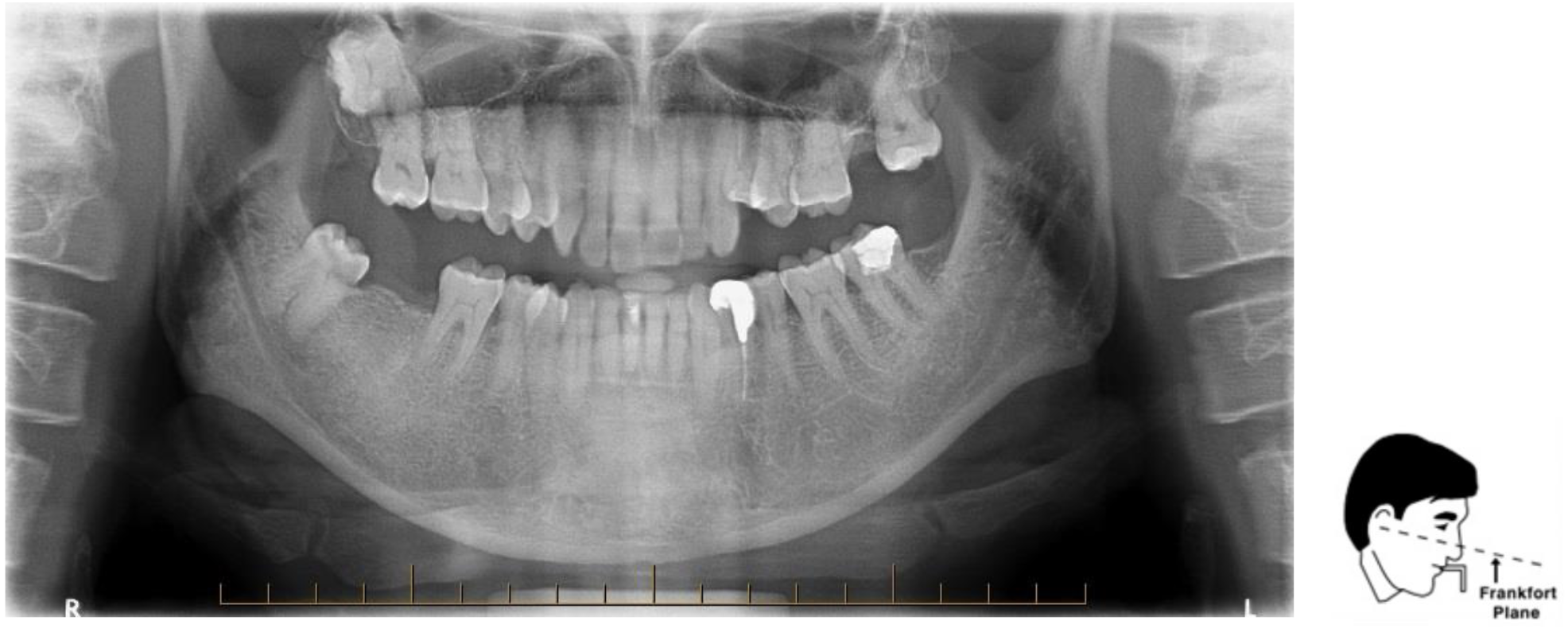 <p>Chin tipped too low</p><p>“V-shaped” jaw/Joker smile appearance, condyles extend to top of film and may be cut off, spine forms arch</p><p>Fix: Get patient to raise chin slightly so that Frankfort plane is parallel to floor</p>