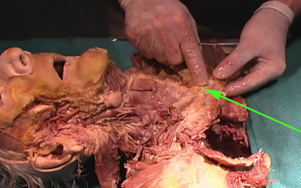 <p>What is the name of this structure to which this arrow is indicating?</p><p> </p><p>sternocleidomastoid</p><p> </p><p>clavicle</p><p> </p><p>sternum</p><p> </p><p>masseter</p>