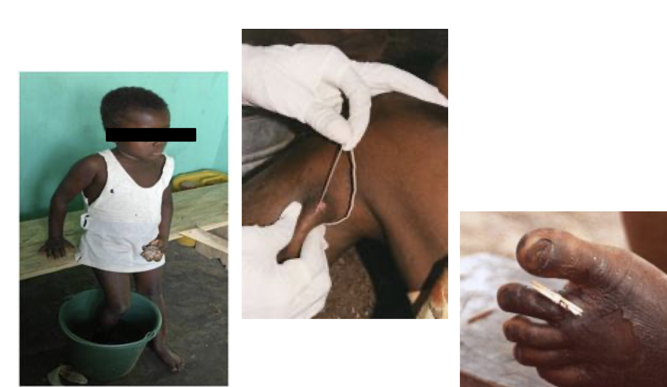 <p>What parasite are these patients being treated for?</p>