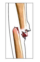 <p>fracture</p>