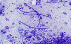 <p>Besides neoplastic melanocytes, the impression smear of the oral mass revealed microfilariae. </p><p>Microfilariae are infective to: </p><p>A) Dog </p><p>B) Human </p><p>C) Mosquito</p>