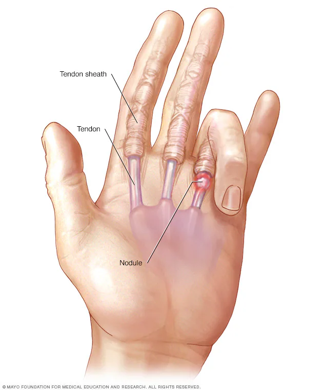 <p>Painful or non-painful catching of flexor tendon at A1 pulley. Causes stenosing tenovaginitis and presence of distal palmar crease. Palpable and tender nodule.</p><p>Conservative: Modalities, orthosis, ROM, tendon gliding</p><p>Cortisone or surgical resection</p>