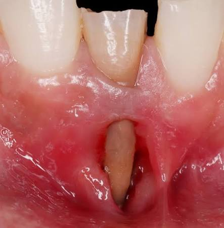 <p>an isolated “window” of missing cortical bone in which the marginal (alveolar crest) bone remains intact</p>