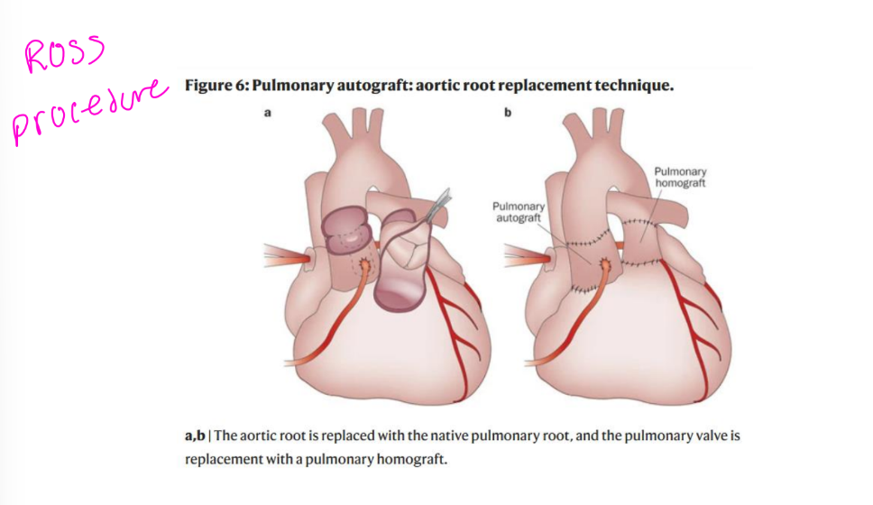 <p>Known as switch procedure</p><p>Donald Ross, MD pioneered this surgery in 1967 for diseased</p><p>aortic valves</p><p>Performed on patients younger then 40 to 50 to avoid long-term</p><p>anticoagulation</p><p>Patient’s own pulmonary valve (autograft) placed in aortic valve</p><p>position and coronaries reimplanted</p><p>Pulmonary allograft (cadaver valve) placed in pulmonic position</p>