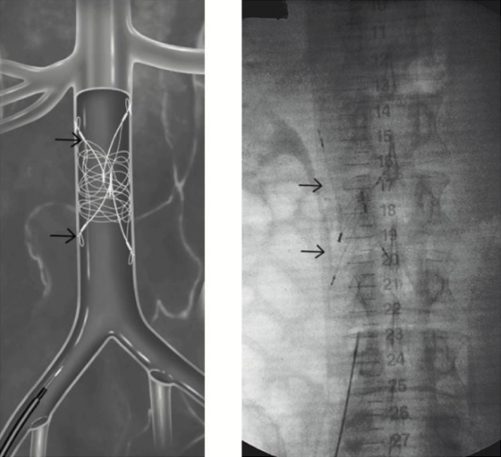 <p>IVC filter</p>