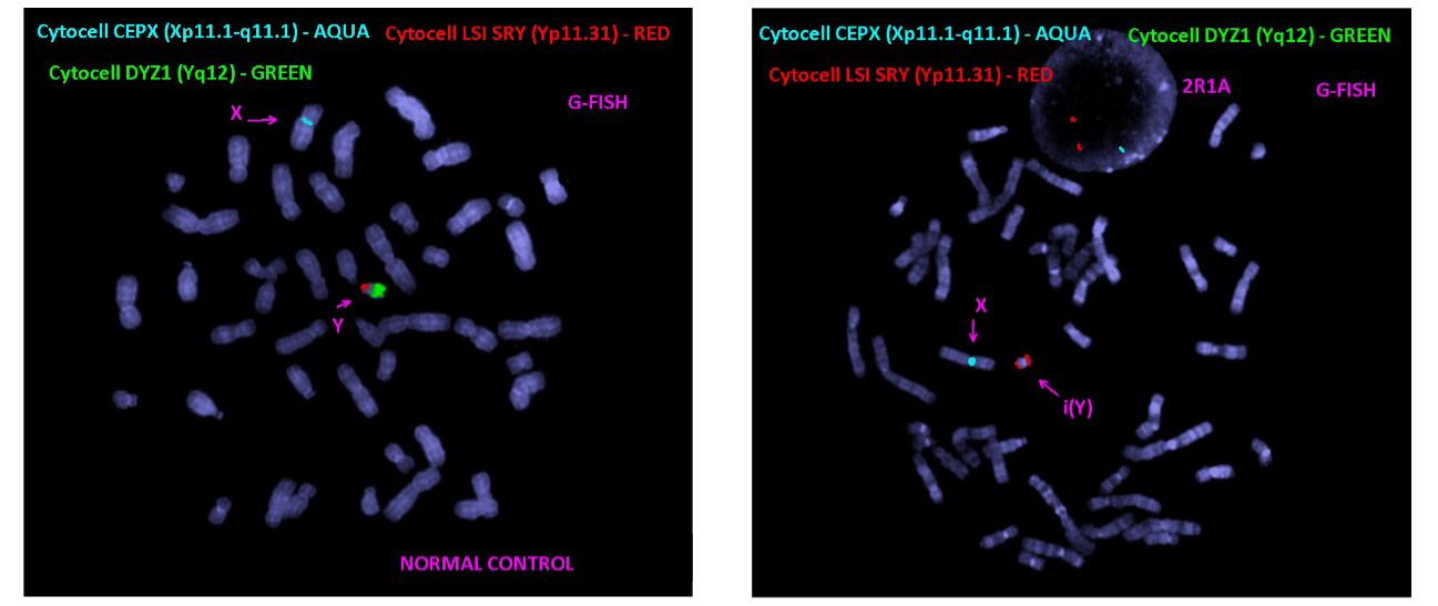 <p>****Going back to the example of the 27yo male with fertility (SHORT Y chr. from karyotype) a FISH was used</p><ul><li><p>What can be interpreted from the FISH results</p></li><li><p>Normal on left. Patient on Right</p></li><li><p>WHY did he have INFERTILITY</p></li></ul><p></p>