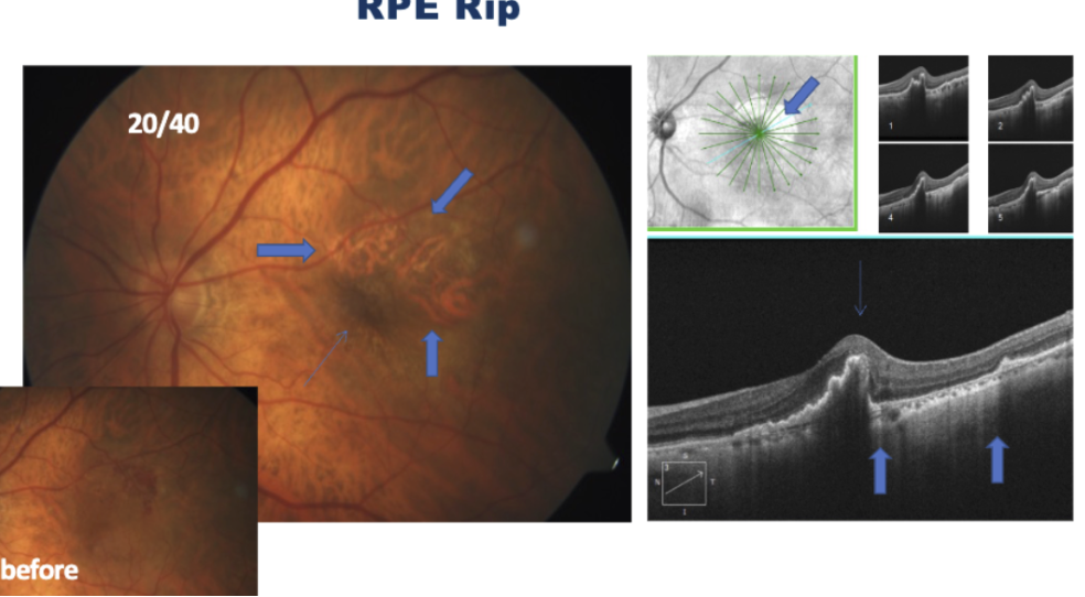 <ul><li><p>Consequence of anti-VEGF injections</p></li><li><p>Common with PED</p></li><li><p>If choroidal vessels are clear, and there is shadowing in adjacent area → indicates RPE is bunched up after getting displaced</p></li></ul><p></p>
