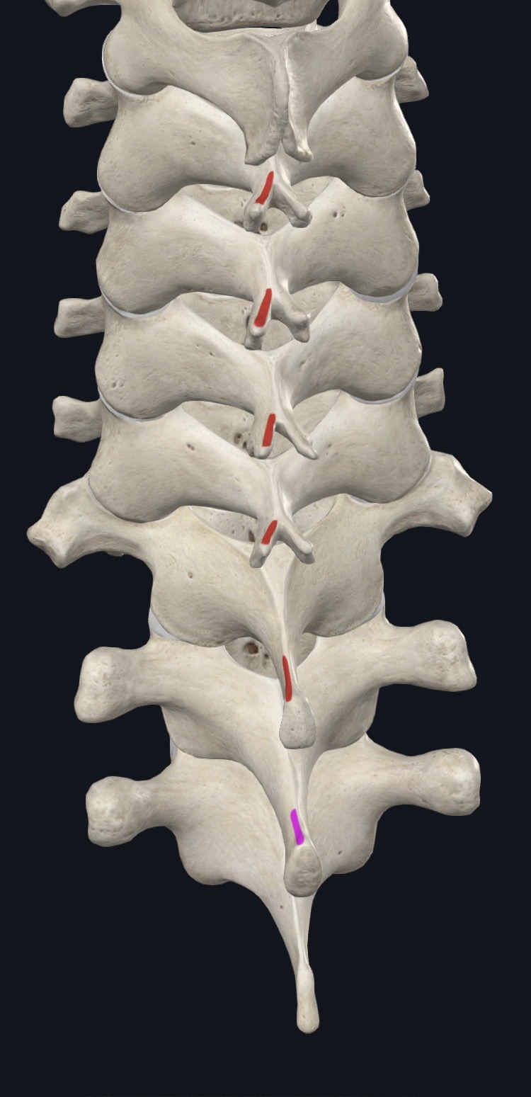 <p>Superior surfaces of spinous processes of cervical and lumbar vertebrae</p>