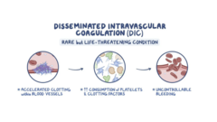 <p>The main cause is an underlying disease process, with severe infections (sepsis) being the most common cause, followed by cancer and major trauma.</p><p>- Conditions trigger widespread clotting, which then consumes platelets and clotting factors, leading to a dangerous state of both clotting and bleeding throughout the body.</p><p>- Systemic syndrome characterized by microthromboses and bleeding or excessive bleeding</p><p>Precipitated by sepsis, trauma, cancer, shock, abruptio placentae, allergic reactions, and other conditions.</p><p>Most cases are associated with infection or malignancy</p><p>Potentially life-threatening</p><p>Symptoms may include: Uncontrollable bleeding from several areas of the body; Bruising; Confusion, memory loss, or change of behavior; Difficulty breathing (dyspnea); Fever that's more than 103</p>