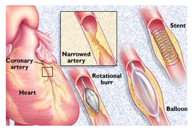 <p>What is <strong>CABG (Coronary Artery Bypass Graft)</strong>? </p>