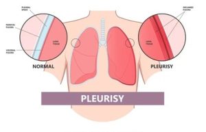<p>Pleurisy</p>