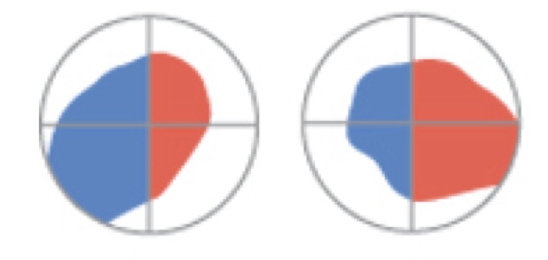 <p>homonymous hemianopia </p>