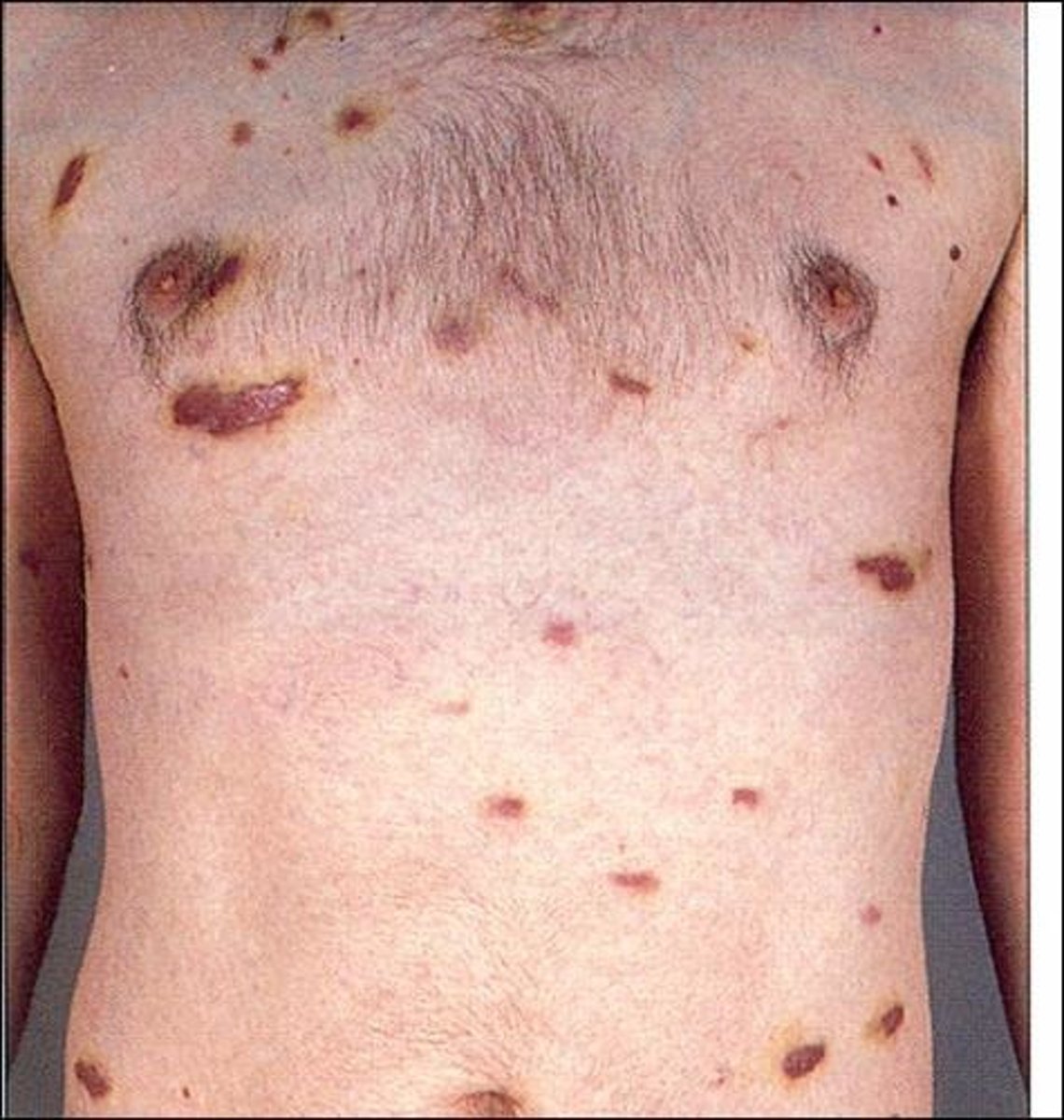 <p>malignant lesion associated with AIDS; arises from the lining of capillaries and appears as red, purple, brown or black skin nodules</p>