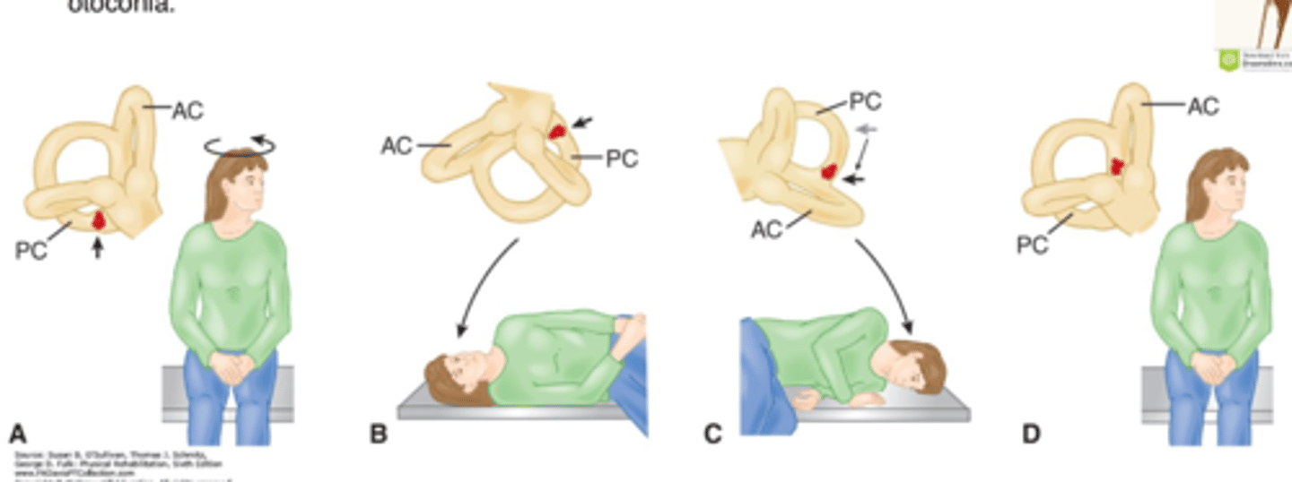 <p>- Head rotated 45 deg to OPPOSITE of involved side first (Example: to the L)</p><p>- With assistance, pt is then moved from sitting to R side lying and stays in this position for 1 min</p><p>- Patient then rapidly moved 180 deg, from R side-lying to L side-lying</p><p>- Head should be in original starting position, L rotated (nose down in final position)</p><p>- Otoconia have been dislodged from the cupola. After 1 min, return to sitting</p>