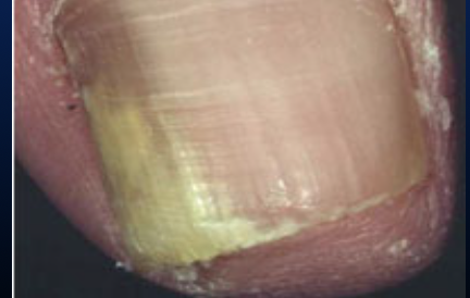 <p>Fungal infection of the nail bed.</p>