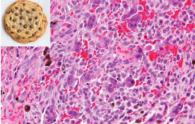 <ul><li><p>chocolate chip cookie like histology</p></li></ul><p></p>