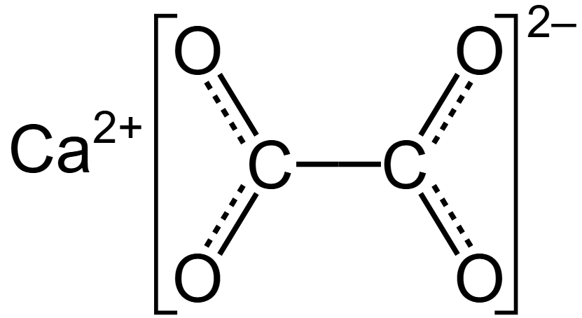 <p>Calcium oxalate stones?</p>
