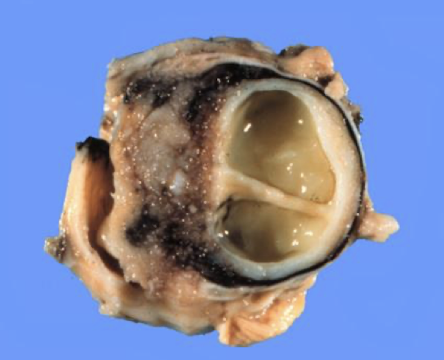 <p>ocular posttraumatic lens tumor in a cat</p><ul><li><p>wide range of where the neoplastic cells will go</p></li></ul><p></p>