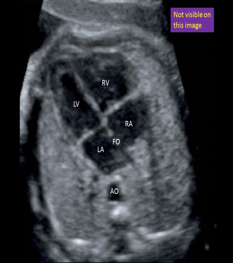 <p>The IVC is not visible in this image. The inferior vena cava is located at a level inferior to the 4 chamber view. The IVC courses up the abdomen into the chest to attach to the inferior right atrium. It is best demonstrated in a sagittal view of the abdomen and chest.</p>
