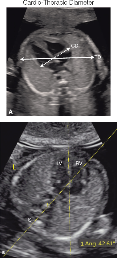 <p> then a cardio/thoracic diameter ratio can be obtained.</p>