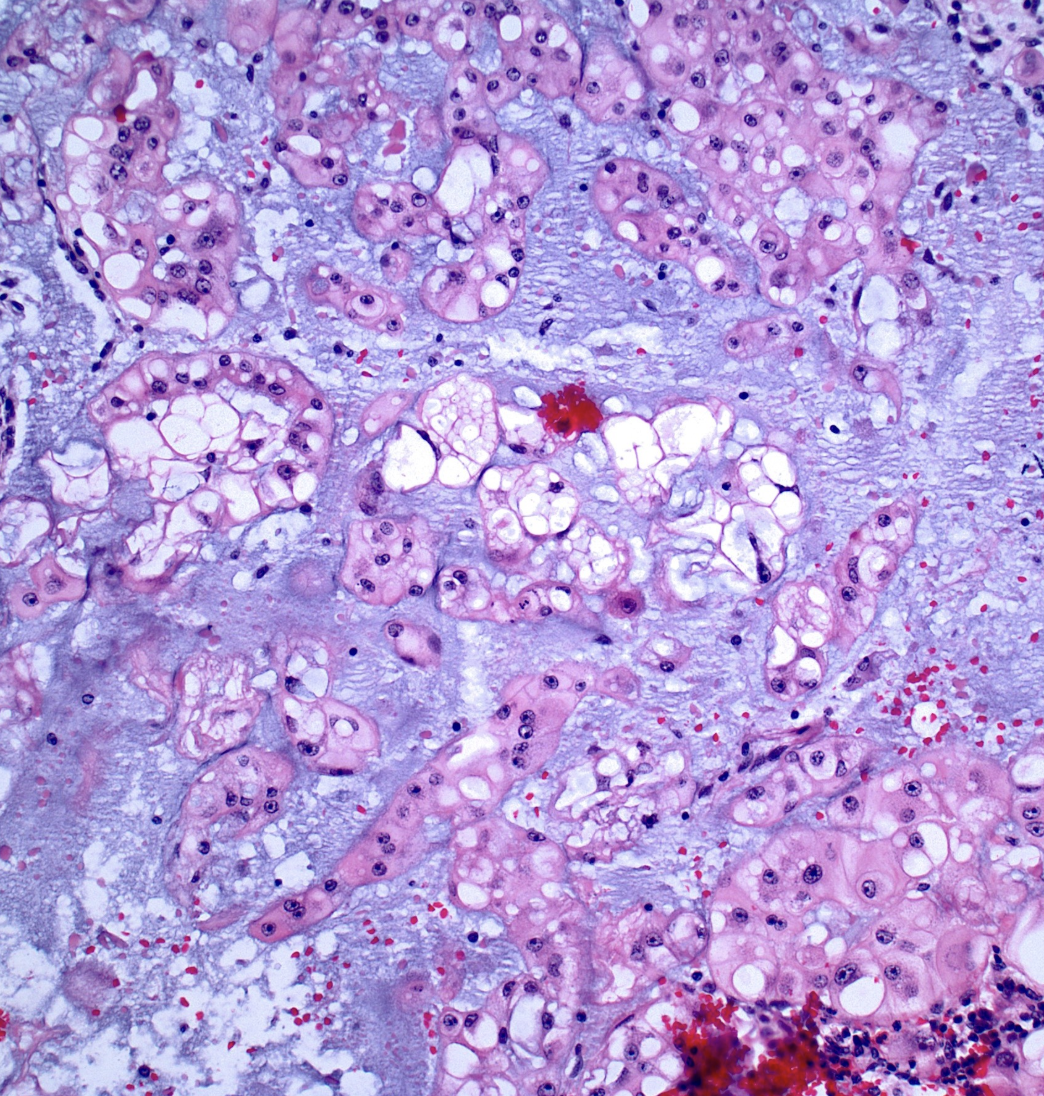 <p>Patient avec tumeur du sacrum</p><p>Diagnostic</p><p>Histologie</p><p>IHC</p>