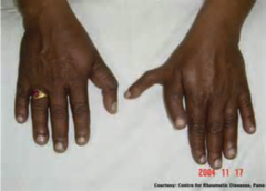 <p>duplication of the thumb(s) or of the halux (great toe)</p>