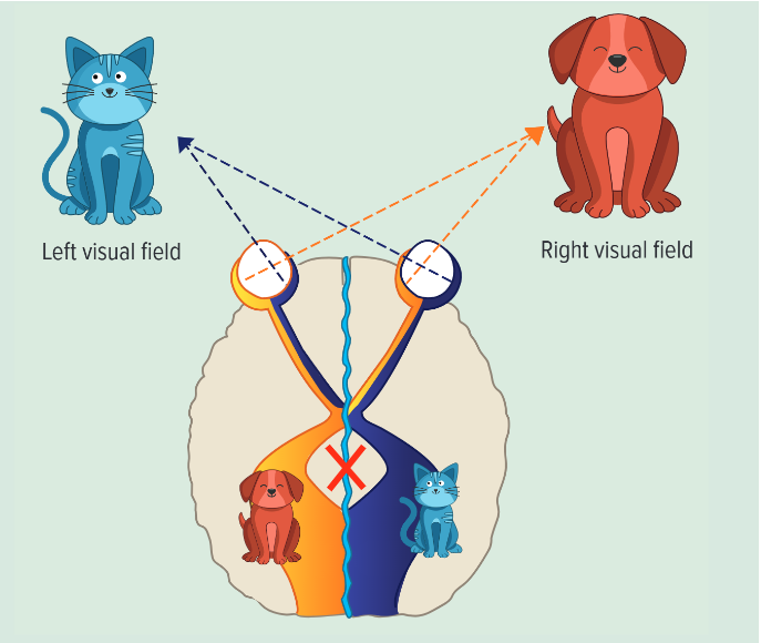 <p></p><ul><li><p>if a dog was shown on the right visual field, they would say they saw a dog </p></li><li><p>if a cat was shown to the left visual field they would say they couldn’t see anything but they were able to draw the cat and then identify what they saw from what they drew </p></li><li><p>this is because info from the left visual field is processed by the right hemisphere which has no language centre so can’t respond verbally but can draw it </p></li><li><p>the left hemisphere which does have a language centre can’t say the cat as there was no way of communicating across the hemispheres as the corpus callosum was severed</p></li></ul><p></p>