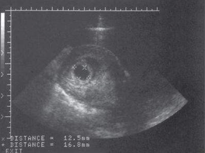 <p>Seen as early as 3-5 weeks; small round/oval anechoic (fluid filled); enclosed by thick echogenic walls;</p><p>Double sac sign: fluid filled gestational sac and uterine cavity identified together and rules out pseudo sac</p>