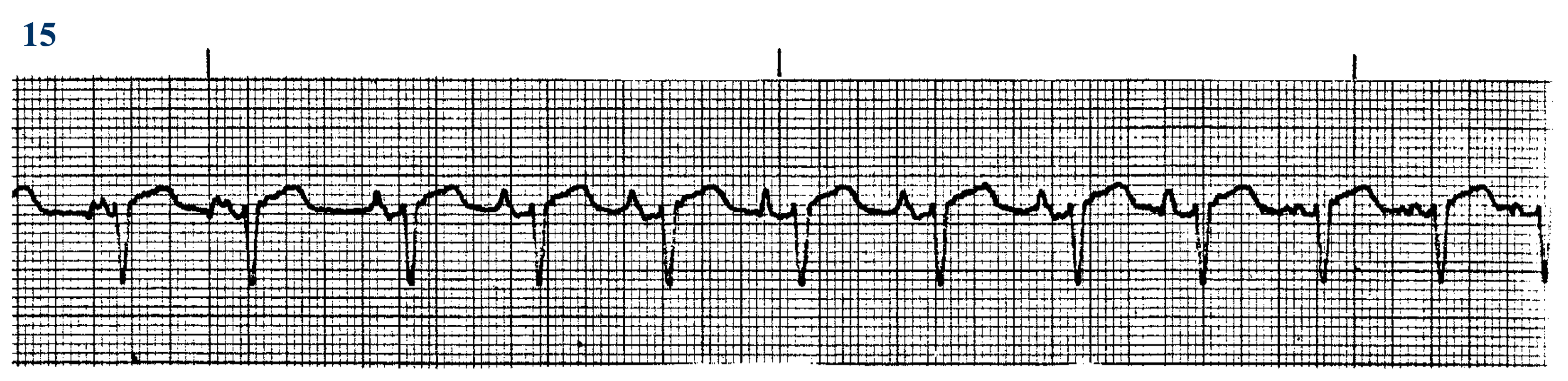 <p>What ECG is this? </p>