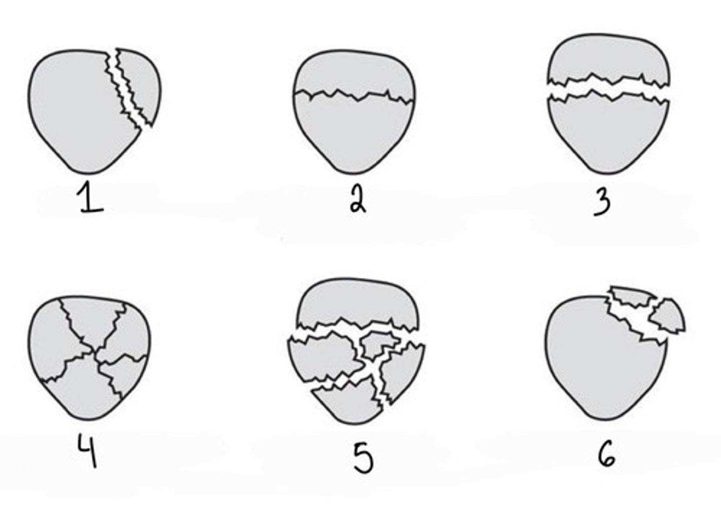 <p>What type of patellar fracture is 4?</p>