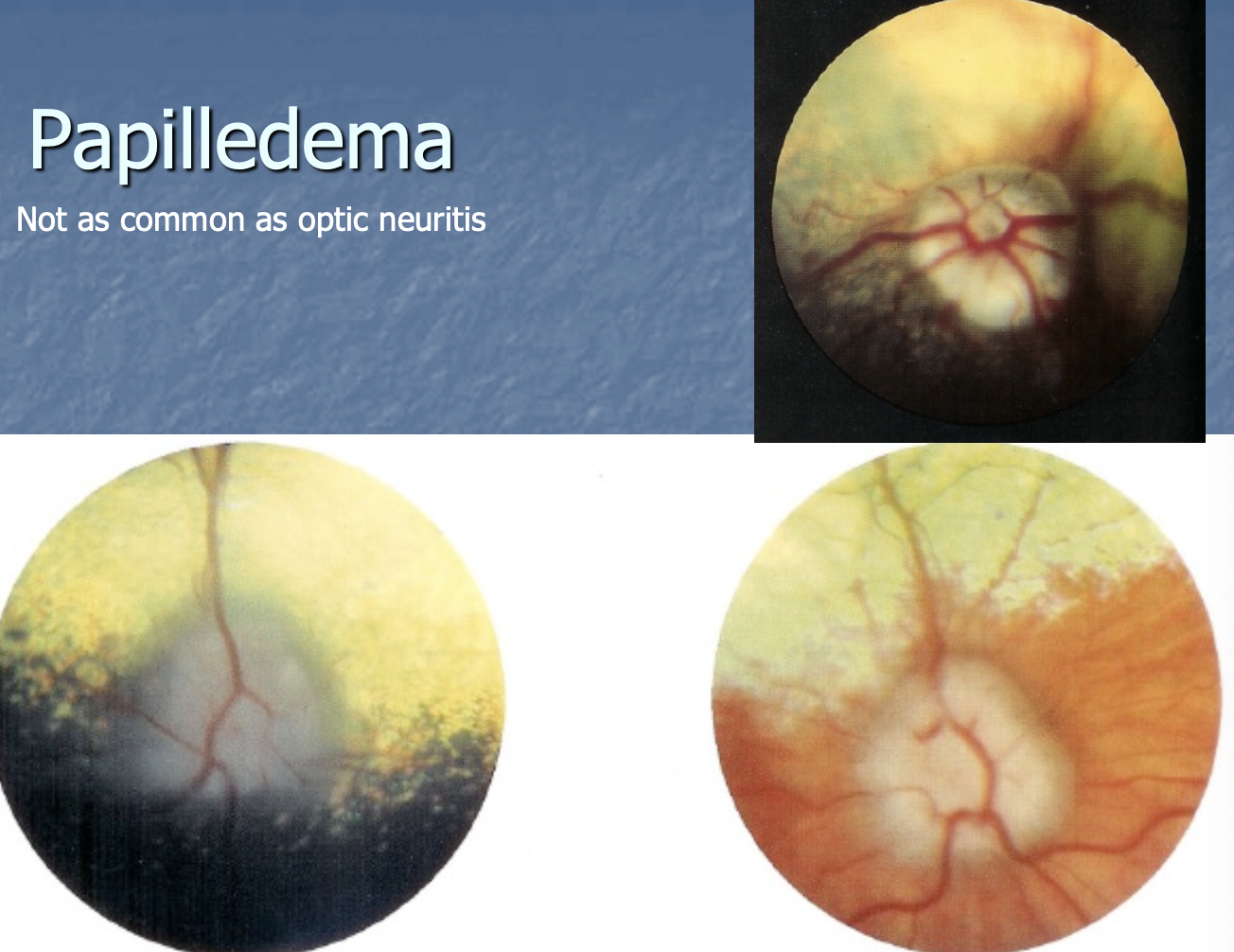 <p>as common as optic neuritis.</p>