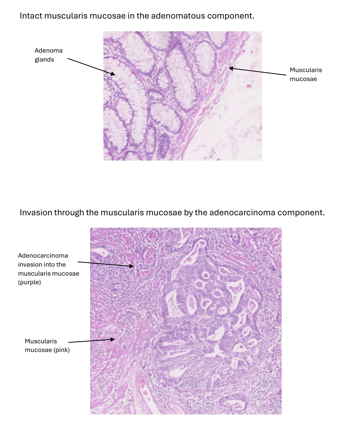 <ul><li><p>For most carcinomas, invasion through the basement membrane is the technical definition of malignancy. An area of invasive adenocarcinoma 8 </p></li><li><p>This is hard to see in colorectal cancers, so, pragmatically, invasion of the muscularis mucosae is taken instead as the defining visual feature of malignancy</p></li></ul><p></p>