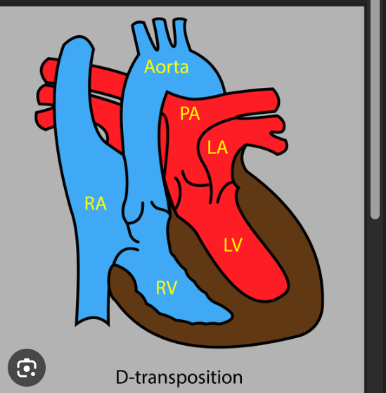 <ul><li><p><strong>Cyanotic</strong></p></li><li><p>Hemodynamics similar to <strong>D-TGA</strong></p></li><li><p>Increased pulmonary blood flow causes <strong>CHF</strong></p></li></ul><p></p>