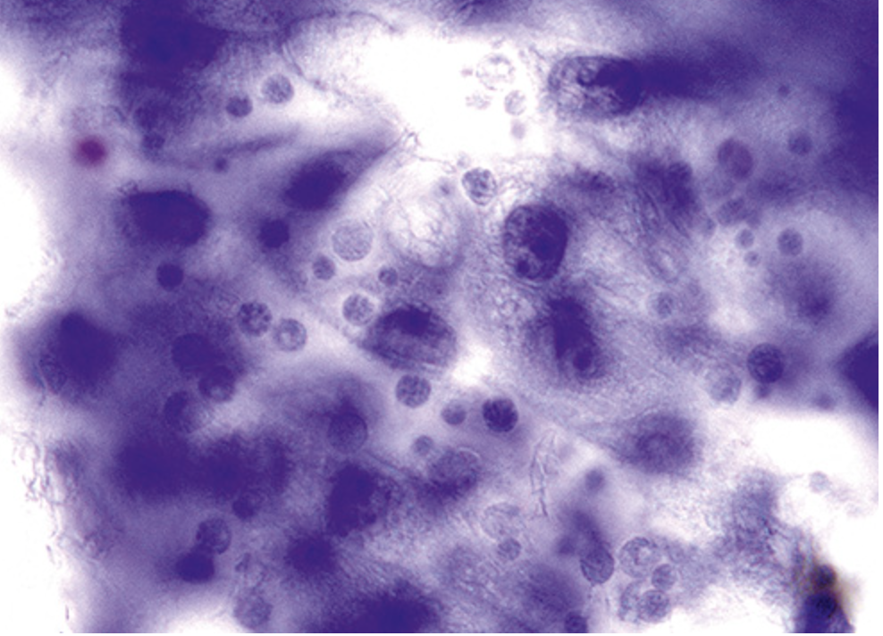 <p>Cytologie duodénale : diagnostic</p>
