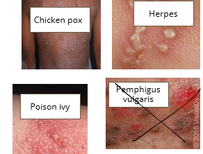 <ul><li><p>Chicken pox</p></li><li><p>Herpetic lesion</p></li><li><p>Poison Ivy</p></li></ul><p></p>