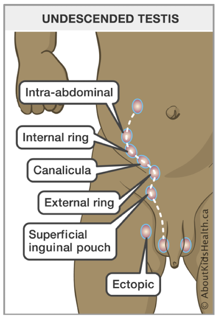 <p>Remain within the <strong>abdomen</strong> or descend only to the <strong>penoscrotal</strong> <strong>junction</strong> instead of reaching the scrotum.</p>