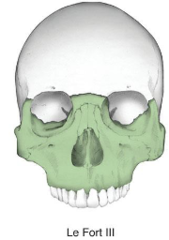 <p>fracture than involves complete discontinuation of skull from the face</p><p>extends through nose and along medial wall of orbit, through floor of orbital and through lateral orbital wall and zygomatic arch, and through sphenoid</p><p>may involve CSF leak!!</p>