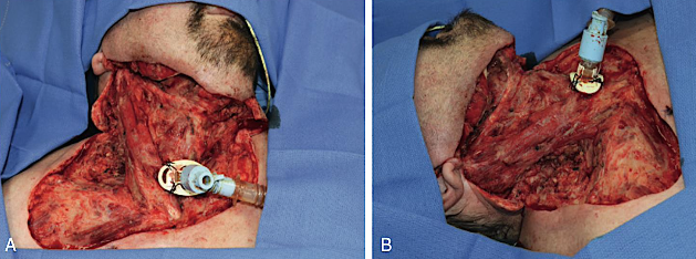 <p><strong>aka:</strong> <em>“flesh-eating” bacterial infection</em></p><p>a <span style="color: red;">soft tissue infection</span> characterized by widespread tissue death involving several fascial spaces</p><ul><li><p>unique characteristic:</p><ul><li><p>does<span style="color: red;"> NOT </span>follow the normal fascial planes of the head and neck</p></li></ul></li><li><p>affects the investing layer of the deep cervical fascia, deep to the platysma muscle</p></li></ul><ul><li><p>tx:</p><ul><li><p>removal of the offending source</p></li><li><p><span style="color: red;">aggressive surgical debridement</span></p></li><li><p><span style="color: red;">empiric antibiotics</span></p></li><li><p>medical optimization</p></li></ul></li></ul><p></p>