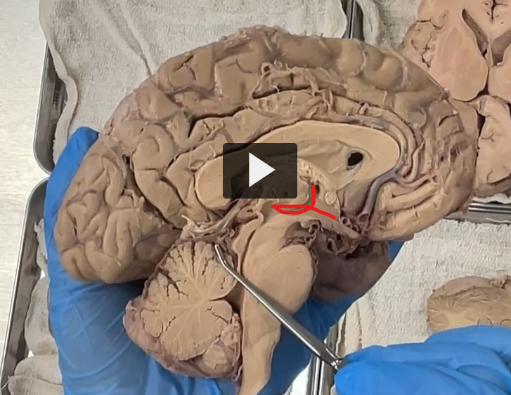 <p>Third ventricle</p><p><strong>Third Ventricle — Etymology &amp; Definition</strong> </p><p> <strong>Etymology</strong> </p><ul><li><p><strong>Latin:</strong></p><ul><li><p><strong><em>ventriculus</em></strong> = “little cavity”</p></li><li><p><strong>third</strong> = refers to its position in the sequence of brain ventricles</p></li></ul></li></ul><p>So, <strong>third ventricle = the “third cavity” of the ventricular system</strong></p><p> <strong>Definition (Neuroanatomy)</strong> </p><ul><li><p>The <strong>third ventricle</strong> is:</p><ul><li><p>A <strong>narrow, midline, slit-like cavity</strong></p></li><li><p>Located in the <strong>diencephalon</strong></p></li><li><p>Lies <strong>between the right and left</strong> thalamus</p></li></ul></li></ul><p></p>