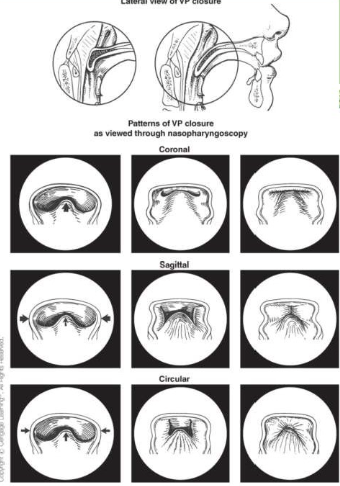 <ul><li><p>coronal: velum & PPW</p></li><li><p>Sagittal pattern: LPW’s least common</p></li><li><p>Circular pattern: all structures, passavant’s ridge </p></li></ul><p></p>