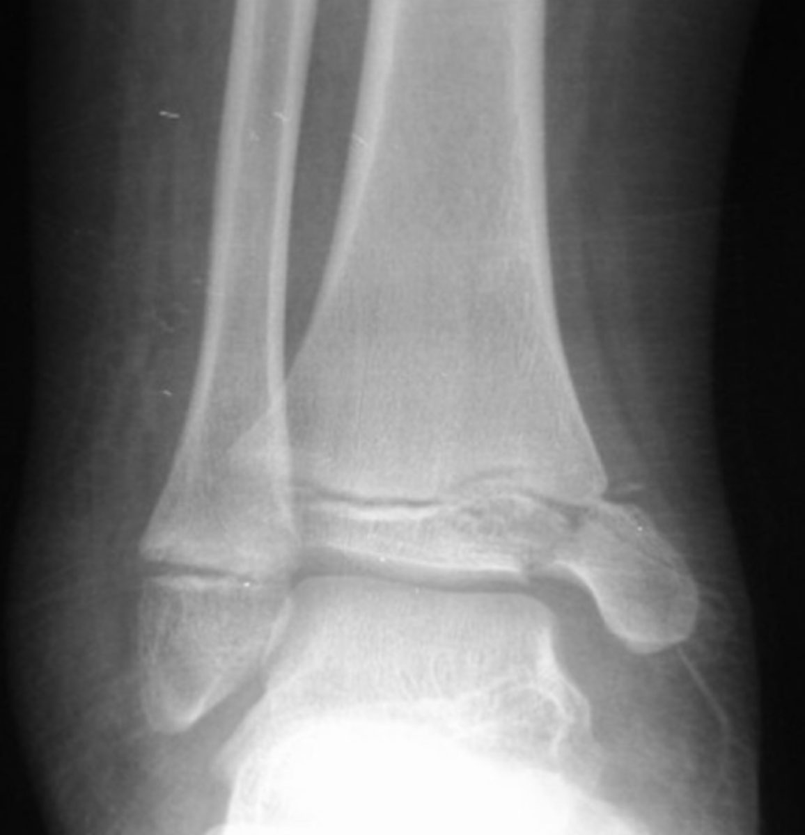 <p>physeal plate fracture with epiphyseal fracture</p>
